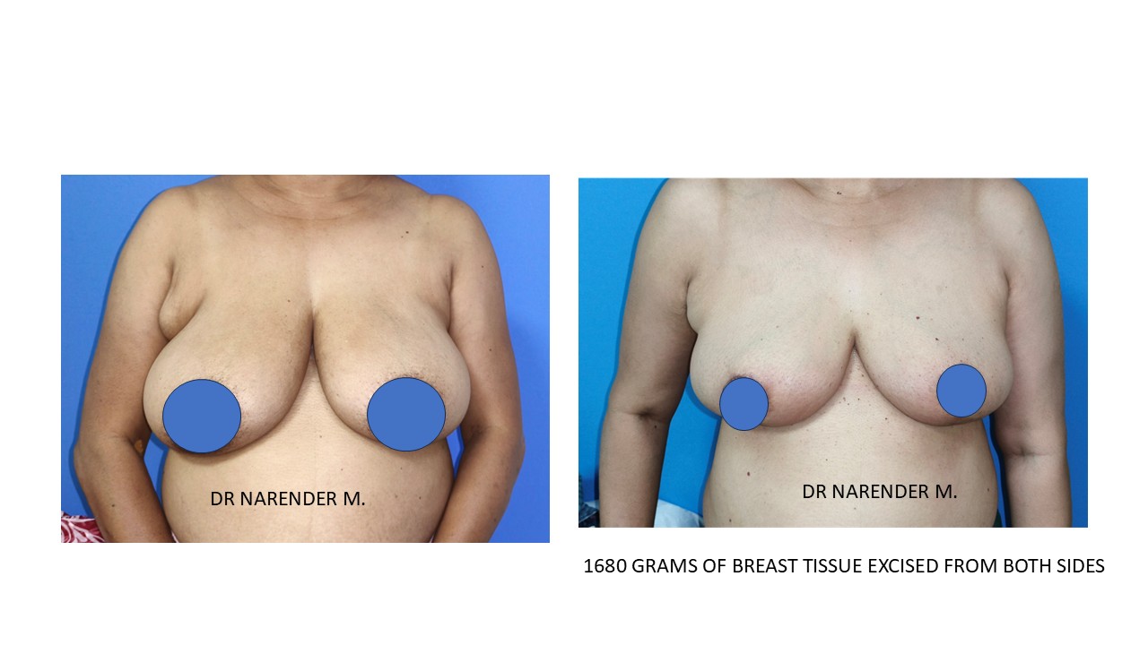 Breast Reconstruction Photo 5